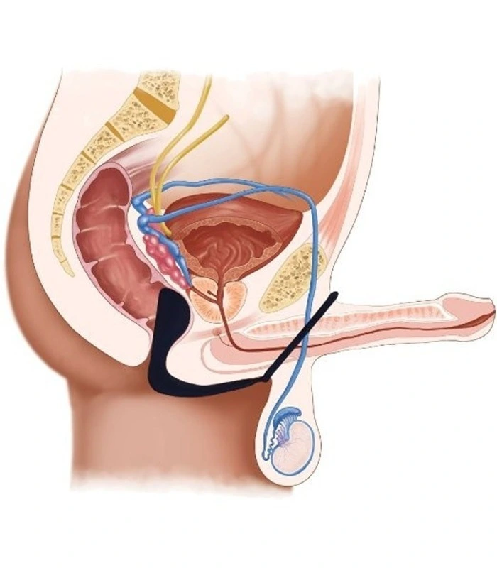 Cockring Plug LT9007 â Image 2